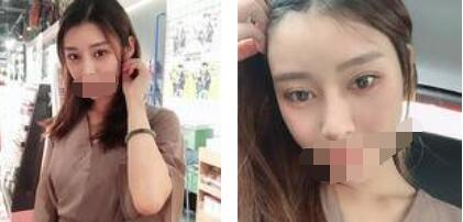 太原歐美蓮整形醫(yī)院丁曉峰醫(yī)生做雙眼皮怎么樣？丁曉峰雙眼皮手術(shù)案例分享