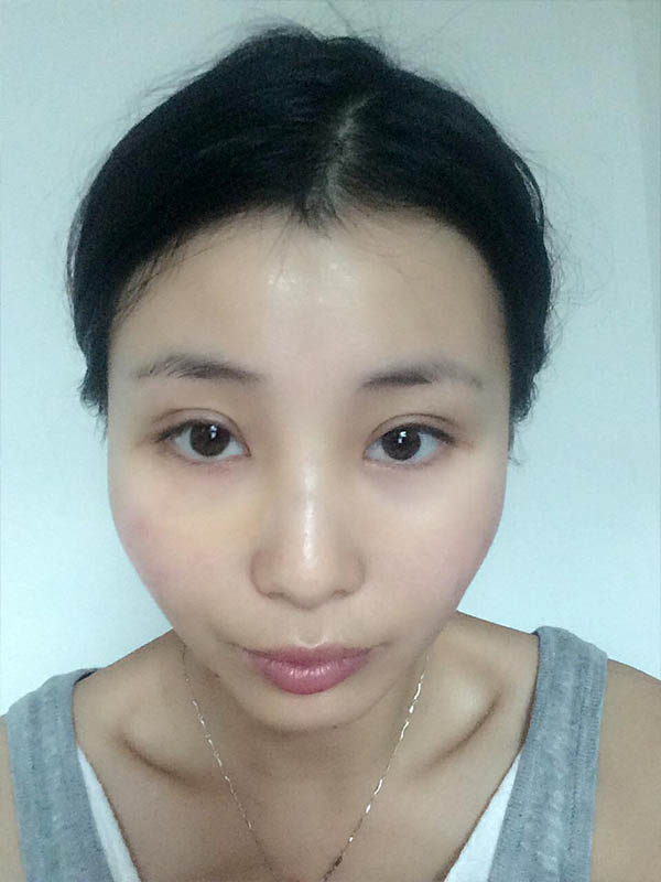 桂林新華醫(yī)療美容醫(yī)生李新華做雙眼皮手術(shù)怎么樣？李新華雙眼皮手術(shù)案例