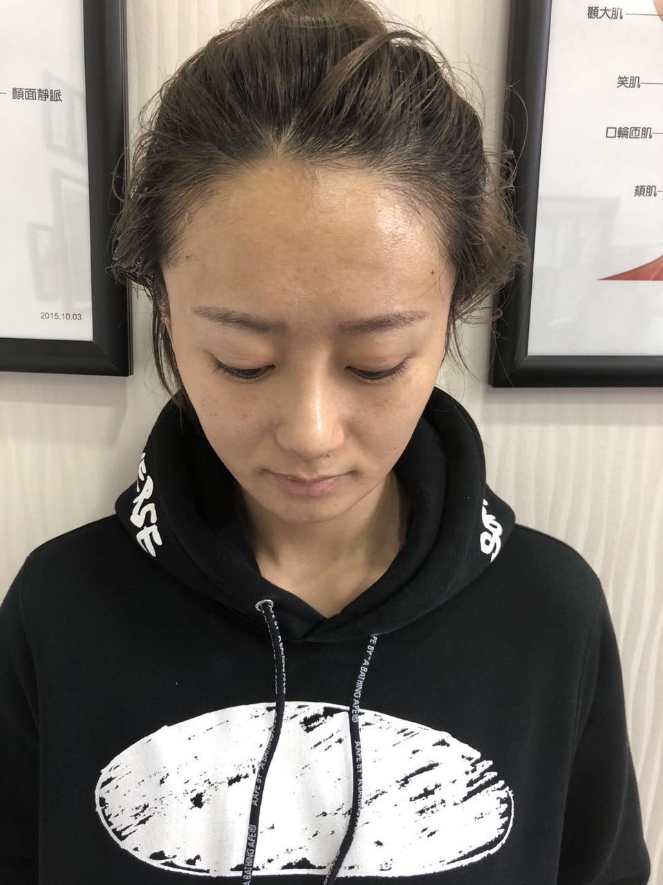 杭州迪美整形常德成醫(yī)生做鼻綜合整形技術(shù)怎么樣？附鼻綜合整形案例