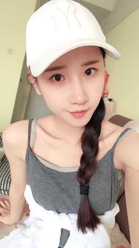 湛江澳泰整形醫(yī)院彭鑫醫(yī)生做自體脂肪豐蘋果肌+太陽穴案例效果對(duì)比圖