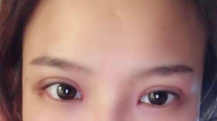 長(zhǎng)春麥西美嘉整形醫(yī)生王圣博做雙眼皮手術(shù)效果怎么樣？附雙眼皮案例