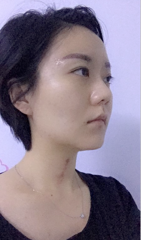 沈陽(yáng)友誼整形美容醫(yī)院金顕哲醫(yī)生做自體脂肪填充臉部+V-LINE瓜子臉手術(shù)案例效果圖