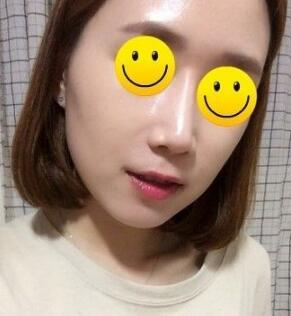 信陽東方藝美容醫(yī)院劉力萌做玻尿酸去法令紋效果怎么樣？附案例效果對比圖