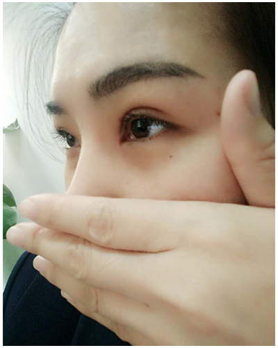 營口臻美醫(yī)療整形醫(yī)生閆迎軍做雙眼皮效果怎么樣？附雙眼皮案例對比圖