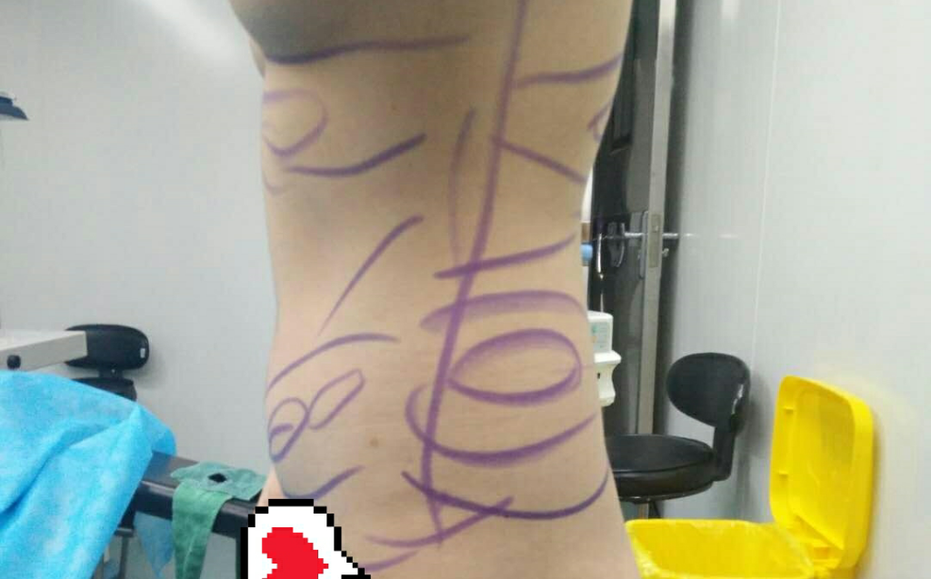 沈陽天使醫(yī)療整形醫(yī)生黃展翼做水動力腰腹吸脂技術怎么樣？附水動力腰腹吸脂案例