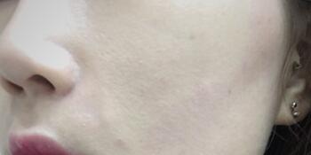 信陽(yáng)東方藝美容醫(yī)院劉力萌做玻尿酸去法令紋效果怎么樣？附案例效果對(duì)比圖