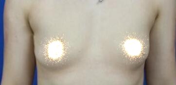 慈溪悅爾整形醫(yī)院趙天宇做自體脂肪隆胸怎么樣？附自體脂肪隆胸案例