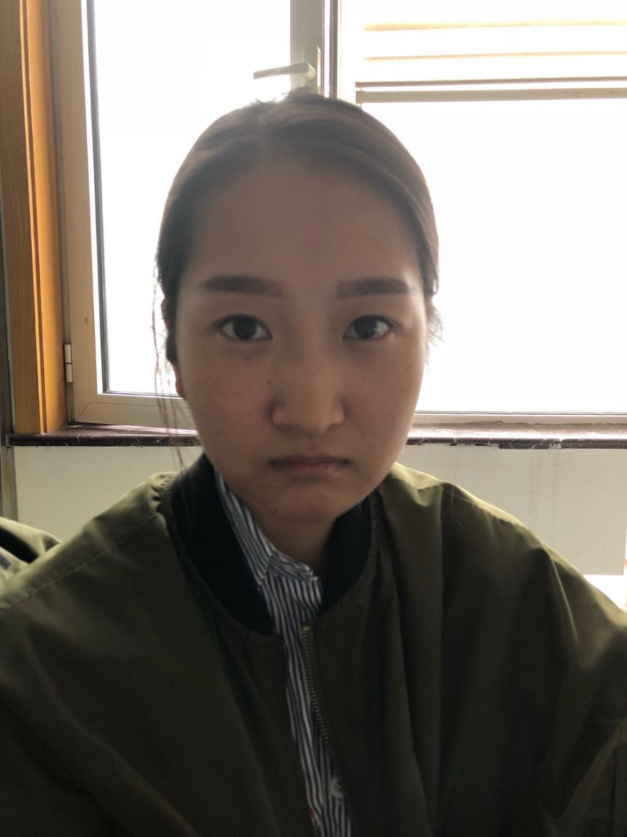 廣州廣大整形美容醫(yī)院任生醫(yī)生做玻尿酸豐面頰+注射瘦臉案例效果對(duì)比圖