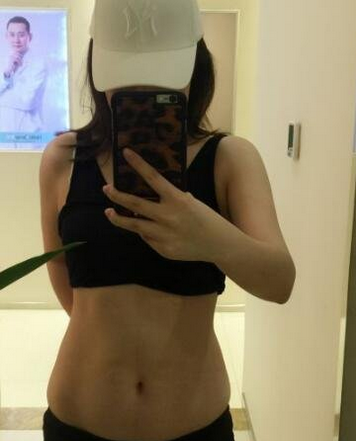 成都蜀尚蓉雅整形醫(yī)生張知華做腰腹吸脂效果怎么樣？附腰腹吸脂案例