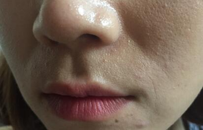 信陽東方藝美容醫(yī)院劉力萌做玻尿酸去法令紋效果怎么樣？附案例效果對比圖