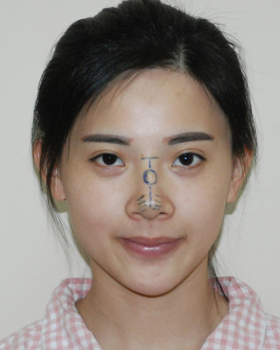 襄陽維多利亞整形醫(yī)院安邰晥醫(yī)生做鼻綜合整形怎么樣？附鼻綜合整形案例