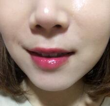 信陽(yáng)東方藝美容醫(yī)院劉力萌做玻尿酸去法令紋效果怎么樣？附案例效果對(duì)比圖