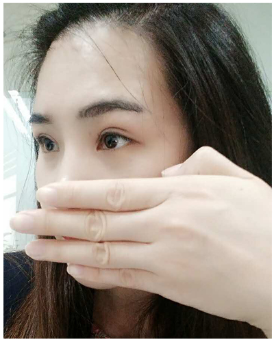 營口臻美醫(yī)療整形醫(yī)生閆迎軍做雙眼皮效果怎么樣？附雙眼皮案例對比圖