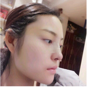 武漢維納斯整形醫(yī)院韓國(guó)濤醫(yī)生做鼻綜合整形怎么樣？附鼻綜合整形案例