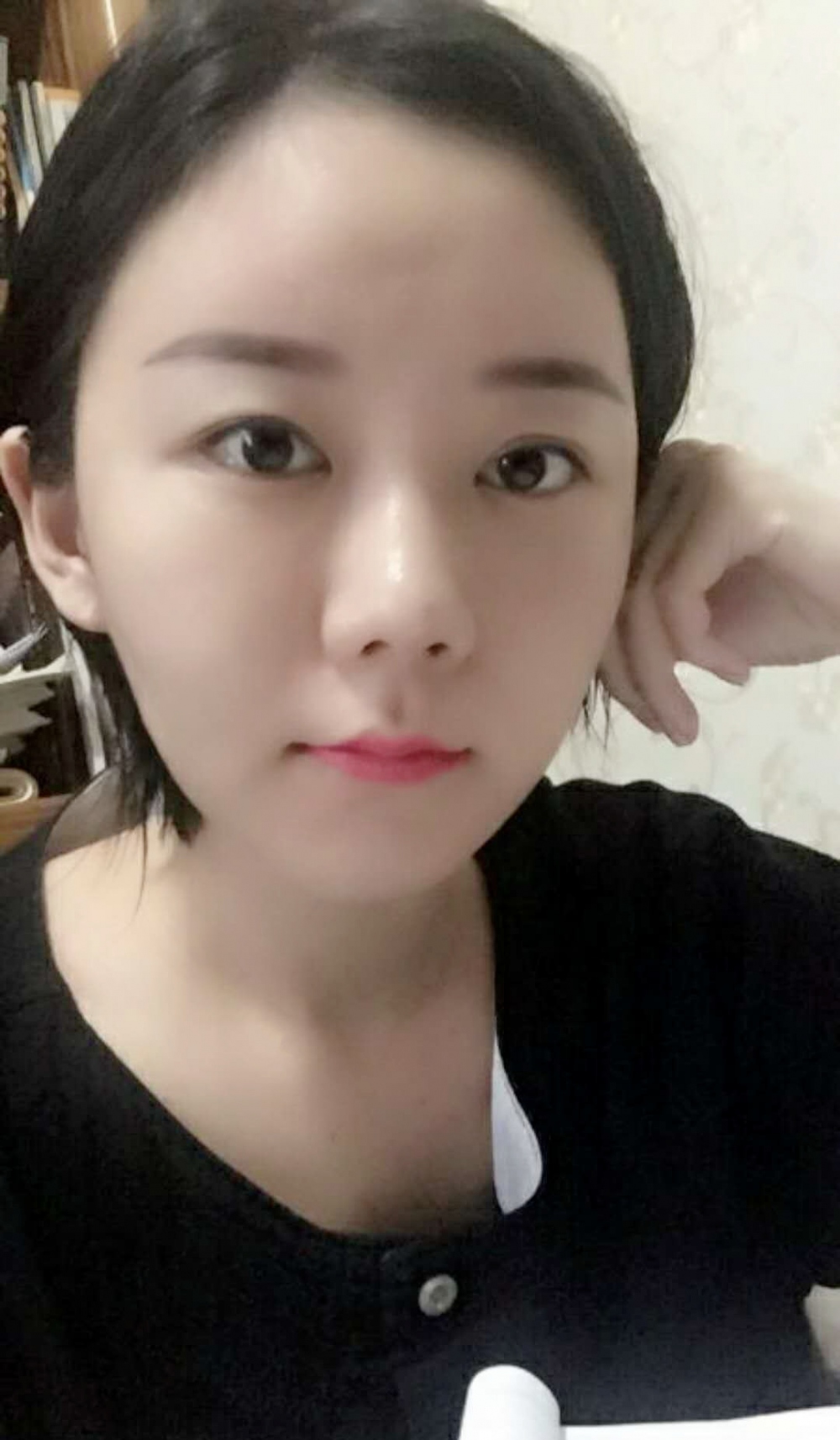 沈陽友誼整形美容醫(yī)院金顕哲醫(yī)生做自體脂肪填充臉部+V-LINE瓜子臉手術(shù)案例效果圖