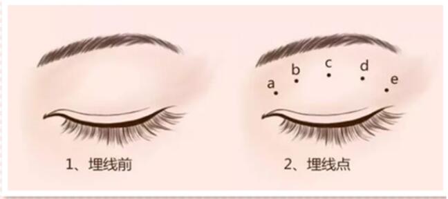 海南省皮膚病埋線雙眼皮