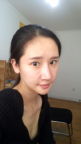 湛江澳泰整形醫(yī)院彭鑫醫(yī)生做自體脂肪豐蘋果肌+太陽穴案例效果對(duì)比圖