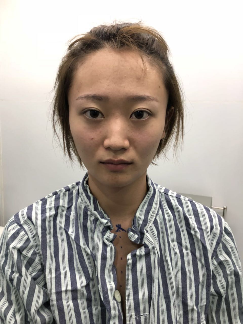 杭州迪美整形常德成醫(yī)生做鼻綜合整形技術(shù)怎么樣？附鼻綜合整形案例