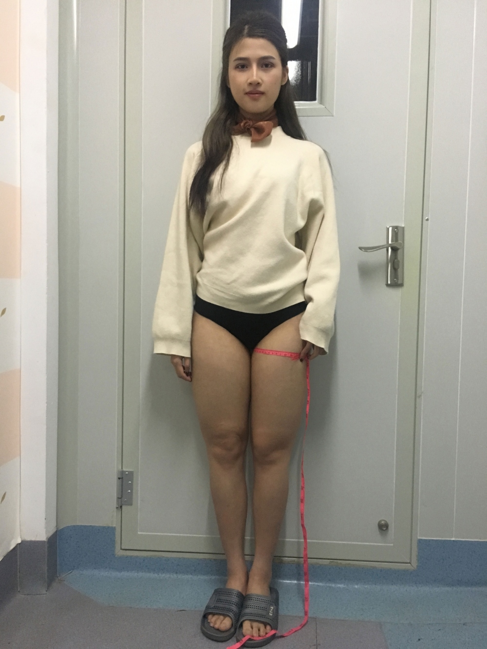 晉城鳳凰整形美容醫(yī)院宋發(fā)興醫(yī)生做大腿吸脂怎么樣？附大腿吸脂案例