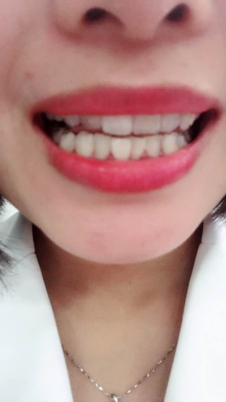 鄭州壹加壹整形醫(yī)院楊永利醫(yī)生做牙齒隱形矯正怎么樣？附牙齒隱形矯正案例