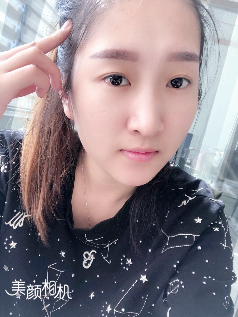 廣州廣大整形美容醫(yī)院任生醫(yī)生做玻尿酸豐面頰+注射瘦臉案例效果對比圖 廣州廣大整形美容醫(yī)院任生醫(yī)生做玻尿酸豐面頰+注射瘦臉案例效果對比圖