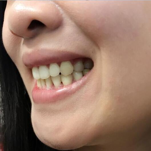 重慶嘉悅口腔醫(yī)院周繼祥醫(yī)生做金屬托槽矯正效果怎么樣？附案例效果對比圖