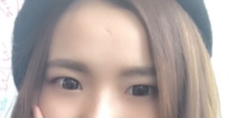 長(zhǎng)春麥西美嘉整形醫(yī)生王圣博做雙眼皮手術(shù)效果怎么樣？附雙眼皮案例