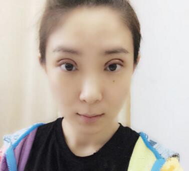 武漢中翰整形外科醫(yī)院陳志鵬醫(yī)生做雙眼皮修復(fù)效果怎么樣？附雙眼皮修復(fù)案例