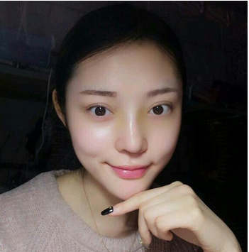 武漢維納斯整形醫(yī)院韓國(guó)濤醫(yī)生做鼻綜合整形怎么樣？附鼻綜合整形案例