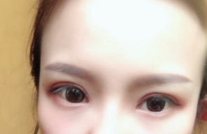 長(zhǎng)春麥西美嘉整形醫(yī)生王圣博做雙眼皮手術(shù)效果怎么樣？附雙眼皮案例