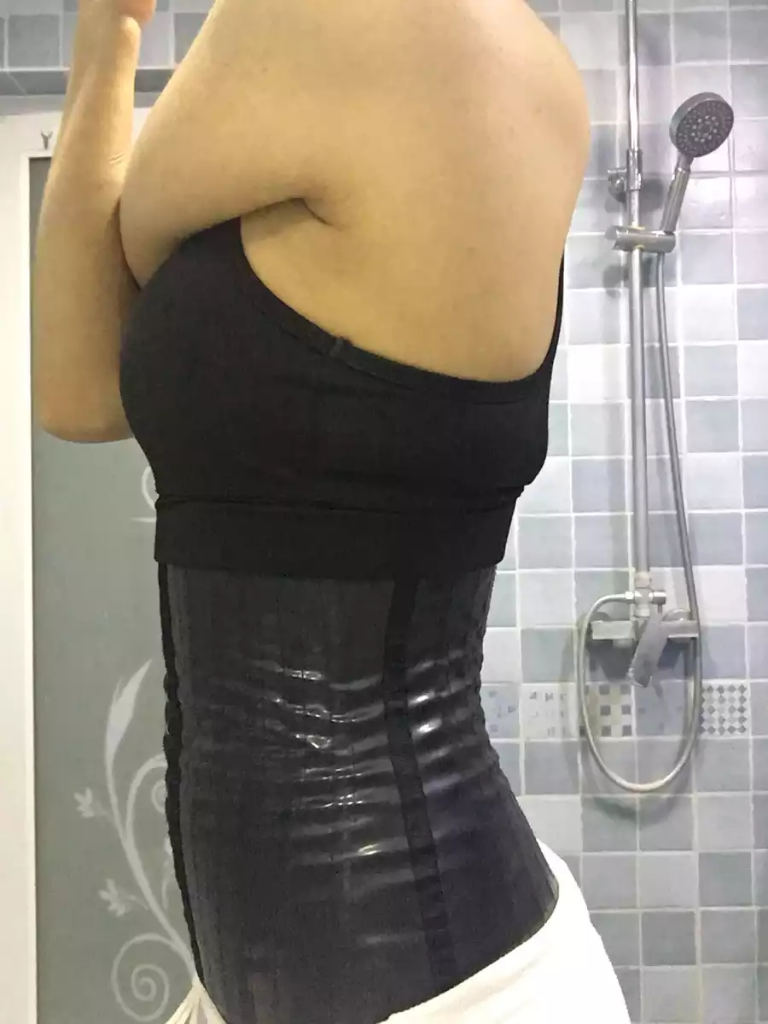 沈陽天使醫(yī)療整形醫(yī)生黃展翼做水動力腰腹吸脂技術怎么樣？附水動力腰腹吸脂案例