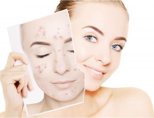 哈爾濱諾依美整形激光去痘印