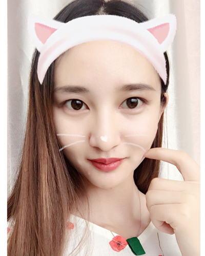 武漢維納斯整形醫(yī)院趙瑾醫(yī)生做玻尿酸墊下巴怎么樣？附玻尿酸墊下巴案例