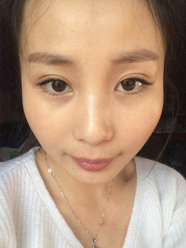 桂林新華醫(yī)療美容醫(yī)生李新華做雙眼皮手術(shù)怎么樣？李新華雙眼皮手術(shù)案例