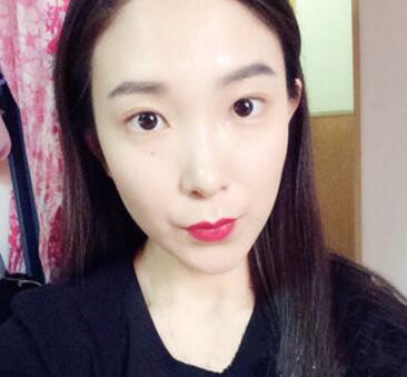 武漢中翰整形外科醫(yī)院陳志鵬醫(yī)生做雙眼皮修復(fù)效果怎么樣？附雙眼皮修復(fù)案例