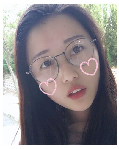 義烏傅氏口腔醫(yī)生朱雨晴做牙齒隱形矯正效果怎么樣？附牙齒隱形矯正案例