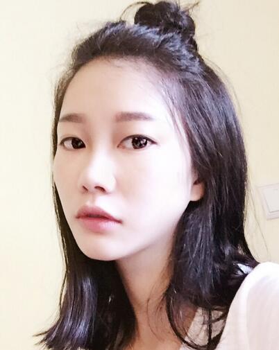 西安陽(yáng)光整形醫(yī)院邵萍醫(yī)生做鼻綜合整形怎么樣？附鼻綜合整形案例