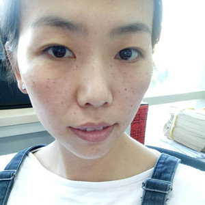 珠海蒂伊醫(yī)療整形醫(yī)生廖俊凱做激光祛斑效果怎么樣？附激光祛斑案例效果圖