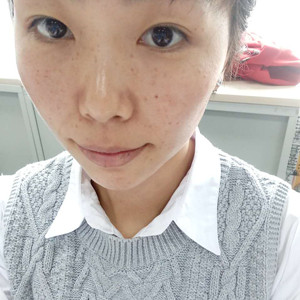 珠海蒂伊醫(yī)療整形醫(yī)生廖俊凱做激光祛斑效果怎么樣？附激光祛斑案例效果圖