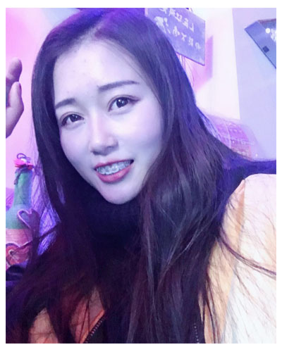 義烏傅氏口腔醫(yī)生朱雨晴做牙齒隱形矯正效果怎么樣？附牙齒隱形矯正案例