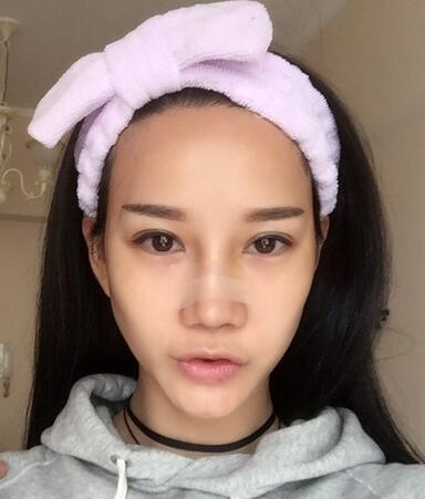 西安陽(yáng)光整形醫(yī)院邵萍醫(yī)生做鼻綜合整形怎么樣？附鼻綜合整形案例