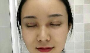 長沙微笑醫(yī)療整形醫(yī)生段雙軍做切開雙眼皮+開內(nèi)眼角效果怎么樣？附案例