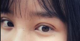 長沙微笑醫(yī)療整形醫(yī)生段雙軍做切開雙眼皮+開內(nèi)眼角效果怎么樣？附案例