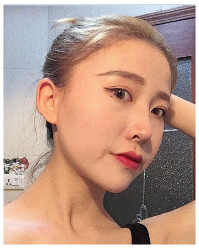 珠海海大整形美容外科黃發(fā)醫(yī)生做面部吸脂怎么樣？附面部吸脂案例