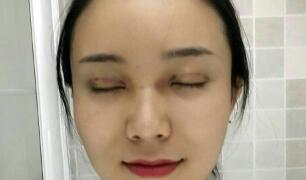 長沙微笑醫(yī)療整形醫(yī)生段雙軍做切開雙眼皮+開內眼角效果怎么樣？附案例