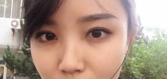 長沙微笑醫(yī)療整形醫(yī)生段雙軍做切開雙眼皮+開內(nèi)眼角效果怎么樣？附案例