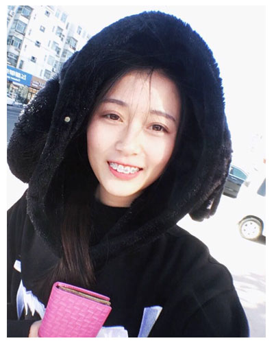 義烏傅氏口腔醫(yī)生朱雨晴做牙齒隱形矯正效果怎么樣？附牙齒隱形矯正案例