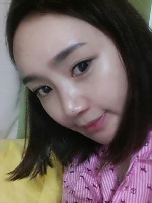 長(zhǎng)春中妍整形醫(yī)院吳學(xué)軍醫(yī)生做玻尿酸墊下巴+玻尿酸豐太陽(yáng)穴案例效果對(duì)比圖