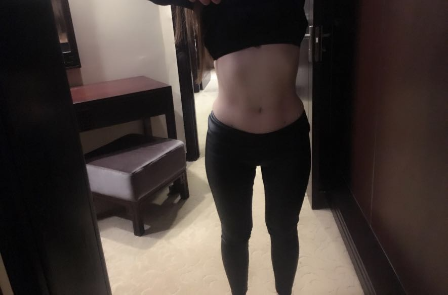 肇慶華美整形醫(yī)院陳巍醫(yī)生做腰腹吸脂效果怎么樣？附腰腹吸脂案例