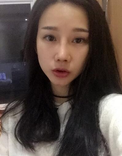 西安陽(yáng)光整形醫(yī)院邵萍醫(yī)生做鼻綜合整形怎么樣？附鼻綜合整形案例